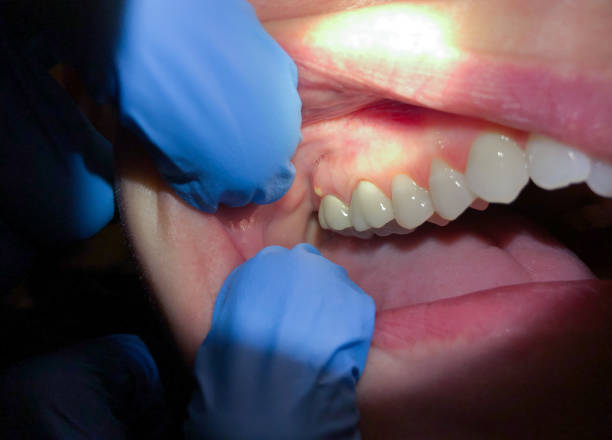 Best Emergency Dental Extractions in Shorewood, IL